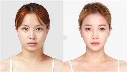 V-line jaw reduction surgery | dr. Saroj k. Sheoran