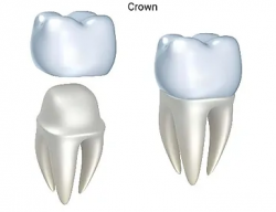 Affordable Dental Crowns in Lynnwood WA