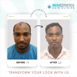 Best Hair Clinic In Lucknow – Neoaesthetica