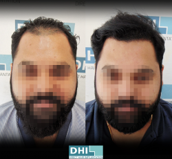 Best Hair Transplant in Costa Rica – DHI International