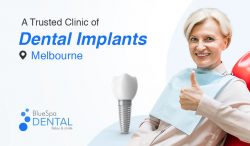 BlueSpa Dental – A Trusted Clinic for Dental Implants in Melbourne