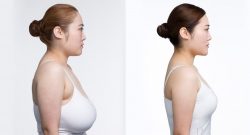 Enhancing Comfort and Confidence: Breast Reduction in Delhi