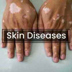 Treatment Of Skin Diseases