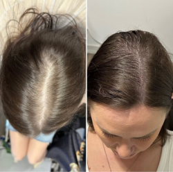 Scalp Micropigmentation Near Me