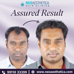 Get Amazing Hair Transplant Results – Neoaesthetica