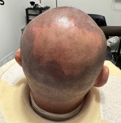 Scalp Micropigmentation Near Me