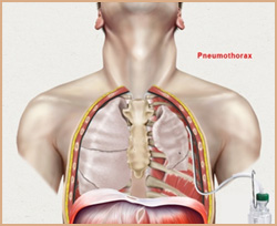 Pneumothorax (Collapsed Lung) Symptoms, Causes and Surgical Treatment in Delhi, India