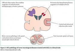 Stem Cells for Multiple Sclerosis