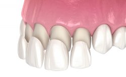 Porcelain Veneers: Unlock Your Perfect Smile’s Potential