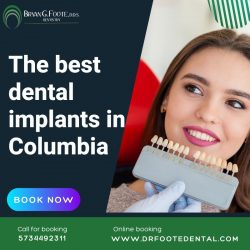 The best dental implants in Columbia