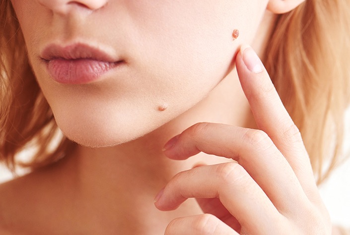 https://www.facebook.com/dermsplaceskintagremover