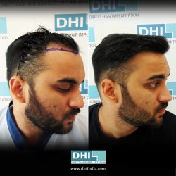 Hair Transplant in Bucaramanga – DHI International