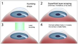 Lasik Eye Surgery Austin Texas