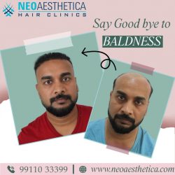 Best Hair Transplant Doctor in Lucknow – Neoaesthetica