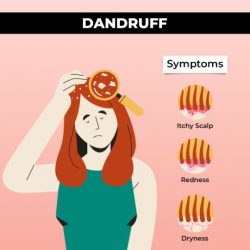 Dandruff Treatment in Hyderabad