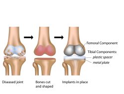 Partial Knee Replacement Surgery