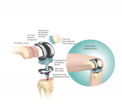 Total Knee Replacement Surgery