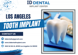 Los Angeles Tooth Implant: Restoring Your Smile with Expert Dental Implants