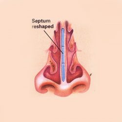 Breathing Comfort with Nose Surgery Septoplasty