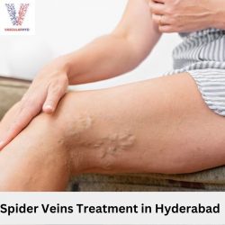 Spider Veins Treatment in Hyderabad | Vascularhyd