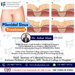 Advanced Laser Treatment for Pilonidal Sinus