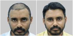 Hair Transplant in Bangalore