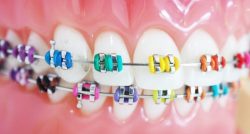 best braces colors for dark skin