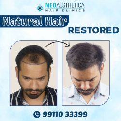 FUE Hair Transplant in Lucknow – Neoaesthetica