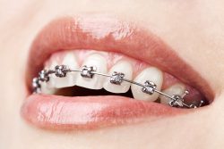 Best Dentist For Braces