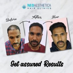 Top Hair Transplant Surgeon In Lucknow – Neoaesthetica