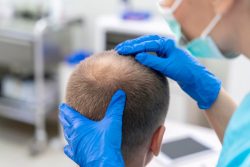 Hair Transplant Surgery Las Vegas