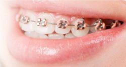 Popular Color in Braces in 2022