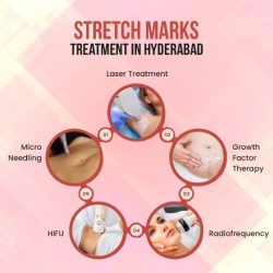 Stretch Marks Treatment in Hyderabad