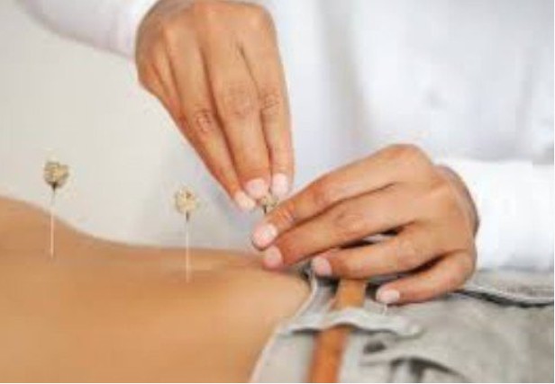 Fertility Acupuncture Bellingham