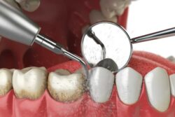 Teeth Cleaning Penrith