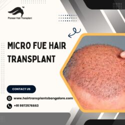 Best FUE Hair Transplant in Bangalore | FUE Hair Transplant Cost