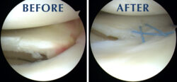 Exceptional Care for Torn Meniscus Repair