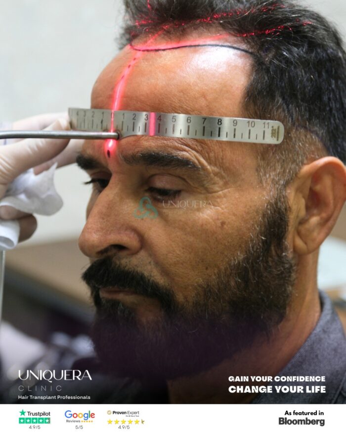 Precision and Artistry with Manual FUE Hair Transplantation at UniqueEra Clinic