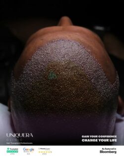 Redefine Your Hairline with Sapphire FUE Hair Transplant at UniqueEra Clinic