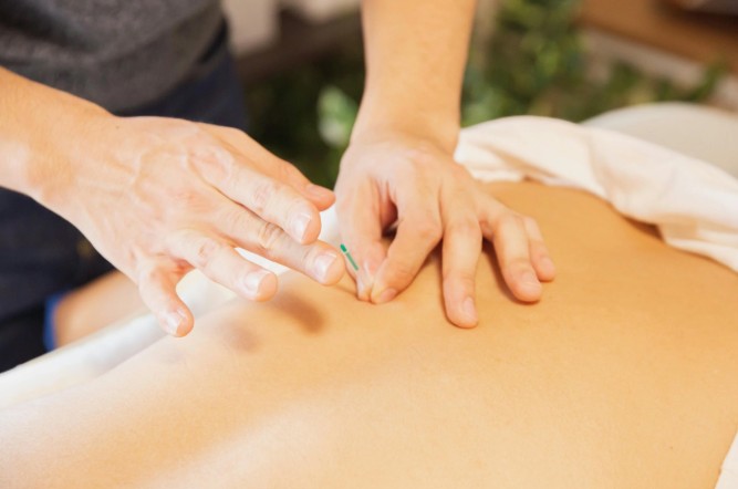 Acupuncture Bellingham