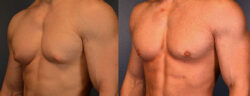 Gynecomastia Surgery in Delhi NCR