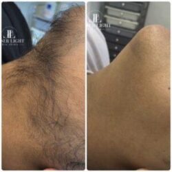 Laser hair removal east London