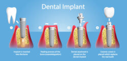 Painless Dental Implants in India
