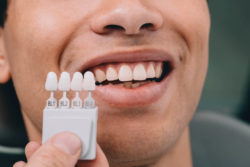 Step-by-Step Guide to Understanding Dental Veneers Cost