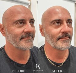 Hydrafacial sydney