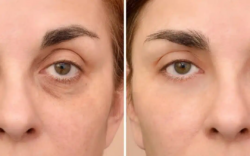Are Under Eye Fillers Perfect for Smoothing Shadows and Under Eye Hollows