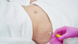 Aqualyx Injection: Can It Help Sculpt a More Elegant Figure?
