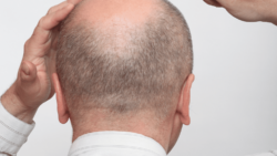 Can Crown Hair Transplant Restore Completely Bald Crown Spots Naturally?