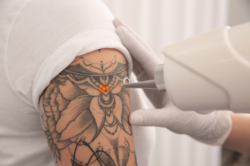 Can Laser Tattoo Removal Fully Erase Black Ink Tattoos?