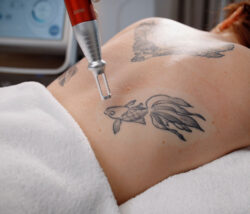 Can Laser Tattoo Removal Remove Old and Stubborn Tattoos?
